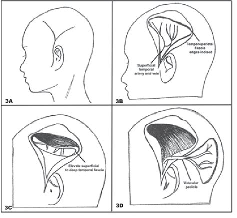 A An Incision Is Made In The Preauricular Area In A Y Shape B The