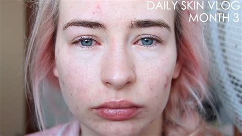 Roaccutane Daily Skin Vlog Month 3 Youtube