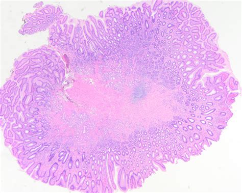 Rectal Polyp Histology