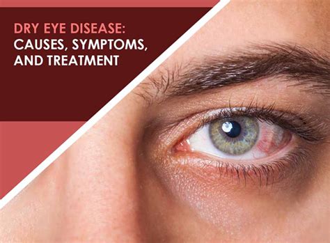 Dry Eye Syndrome: Causes, Symptoms & Treatment » How To Relief