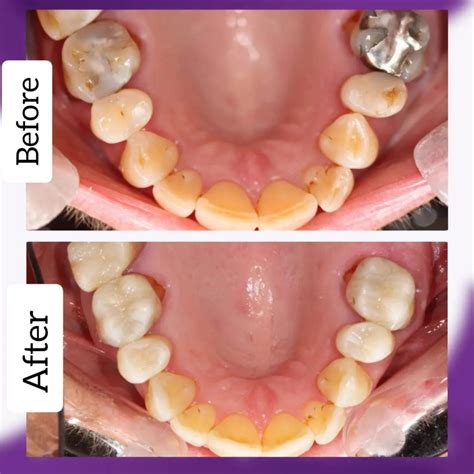 Composite Bonding Fareham Crofton Dental Care