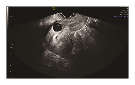 Transvaginal Ultrasound Showing A A Cesarean Scar Ectopic Pregnancy