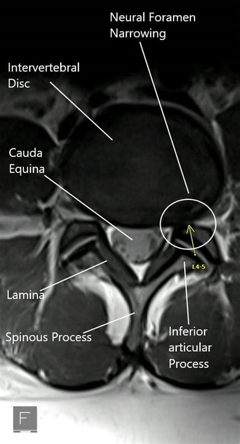 Foramen Spine