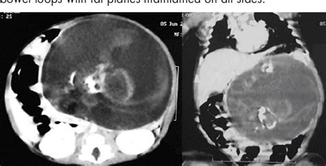Neonate With Retroperitoneal Mature Cystic Teratoma A Case Report