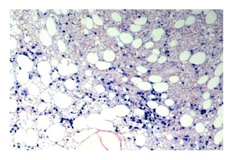 Immunophenotypic Features Of Atypical Lymphoid Infiltrates A H