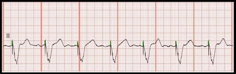 Float Nurse: Practice EKG Rhythm Strips 118