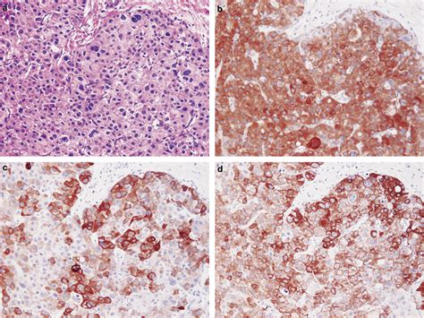 Representative Ezrin Cytokeratin Ck And Ck Expressions In