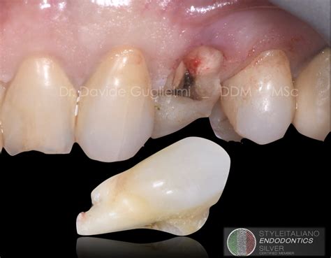 Treatment Of An Extensive Radicular Fracture The Pre Endodontic Restoration Of A Structurally