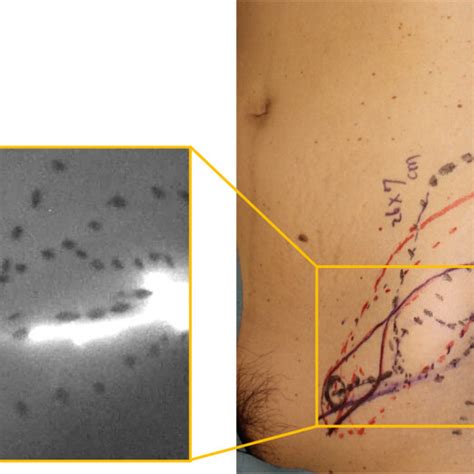 Lymphatic Flow In The Flap Detected By ICG Lymphography ICG