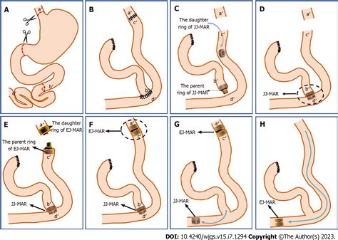 Total Gastrectomy