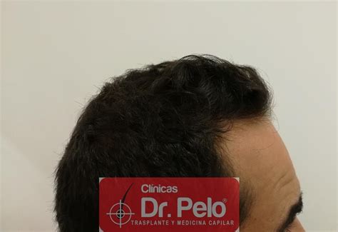 Caso 44 Injerto Capilar Con 1 835 Grafts 3 912 Pelos Dr Junior