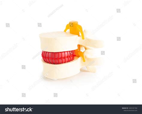 Rachischisis Images, Stock Photos & Vectors | Shutterstock