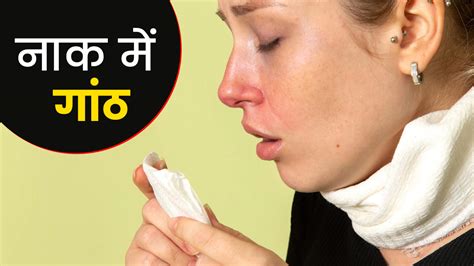 नाक में गांठ होने के कारण और लक्षण Nasal Bone Lump Causes And