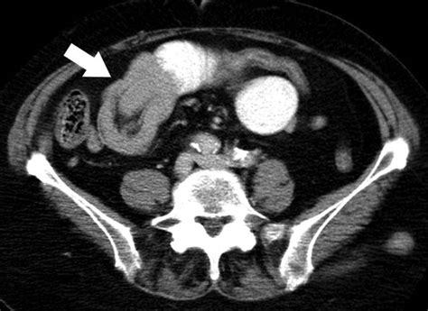 Adult Intestinal Intussusception Ct Appearances And Identification Of