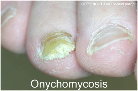 Onychomycosis Treatment