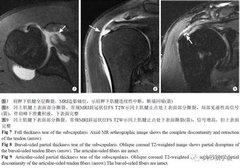 肩关节常见病变MRI诊断