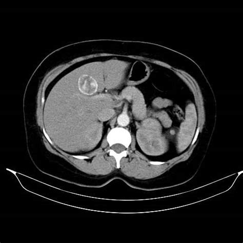 Hepatic Hydatid Cyst Image Radiopaedia Org