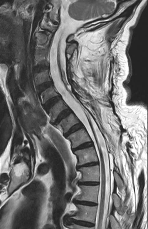 Post Surgery Cervical Spine Philips Mr Body Map