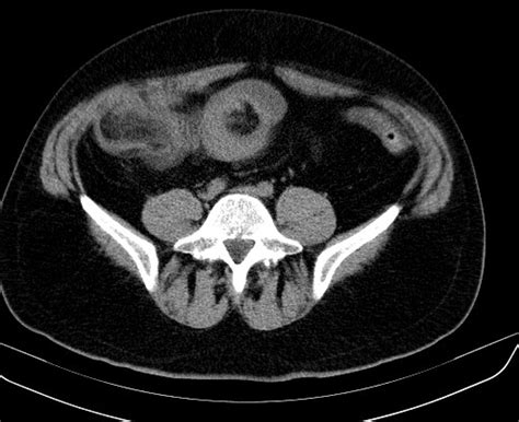 An Abdominal Computed Tomography Scan Shows A Sausage Shape Download Scientific Diagram