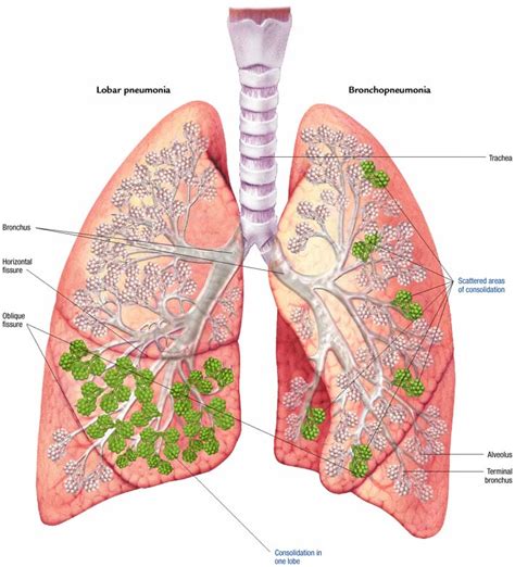 Pathophysiology Of Aspiration Pneumonia