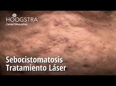 Sebocistomatosis Tratamiento Láser 23102 YouTube