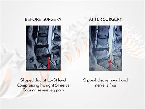 Endoscopic Spine Surgery Slipped Disc Spinal Fusion Surgery Mumbai