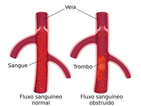 Trombose o que é quais os sintomas causas e tratamento