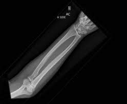 Both Bone Forearm Fracture - Pediatric - Pediatrics - Orthobullets