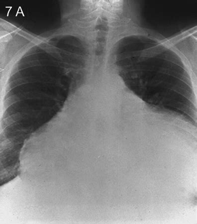 Pericardial Disease