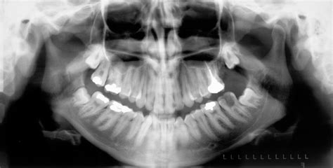 Case Of The Week Condylar Hypoplasia Dr G S Toothpix