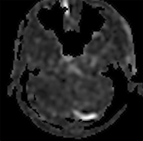 Contemporary Imaging Of Cerebral Arteriovenous Malformations Ajr