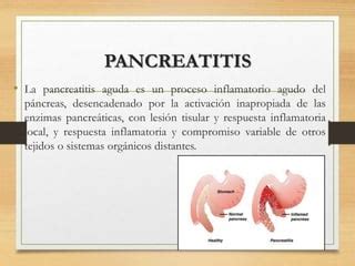 Pancreatitis En El Embarazo Fabian Ppt