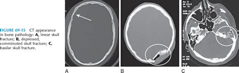 Figure 69 1 From How To Read A Head CT Scan Semantic Scholar