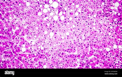 Histopathology Of Liver Steatosis Or Fatty Liver Light Micrograph