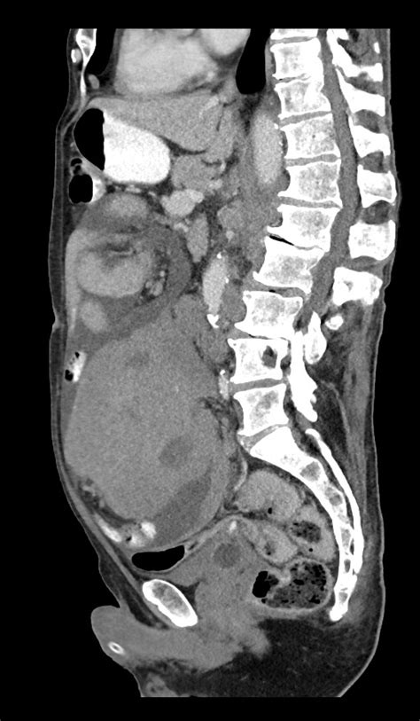 Lymphomatosis Abdominal And Peritoneal Image Radiopaedia Org