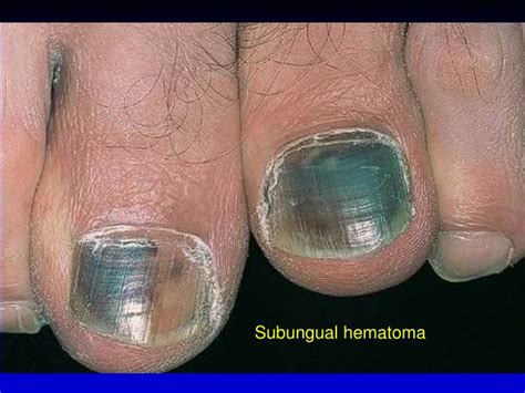 Pseudomonas Nail Infection Icd 10 Nail Ftempo