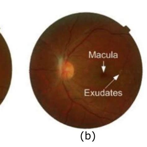 Color Fundus Image Showing Different Stage Of Diabetic Macular Edema Download Scientific