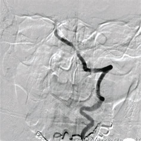 A 58 Year Old Male With Basilar Artery Occlusion Stroke Had An