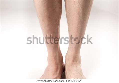 Naked Legs Man Varicose Veins On Stock Photo Shutterstock