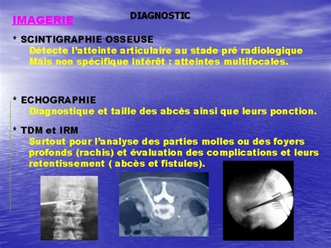 Generalite Sur La Tuberculose Osseuse Et Osteo Articulaire