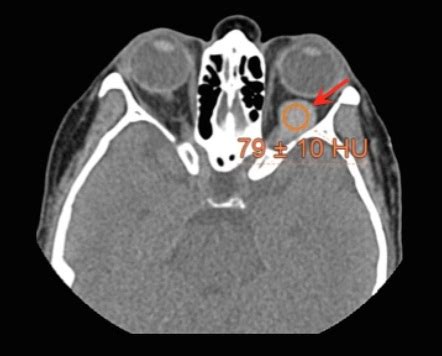 Thrombosed Orbital Varix Image Radiopaedia Org