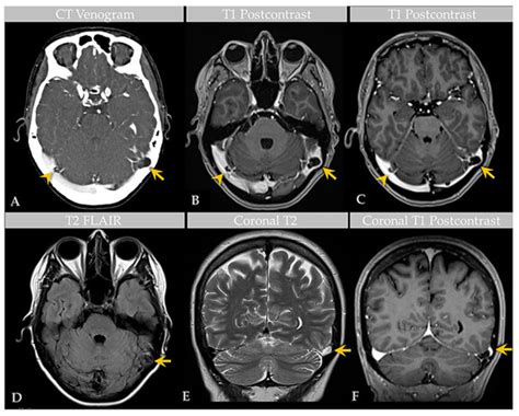 Ijms Free Full Text Giant Arachnoid Granulations Diagnostic Workup And Characterization In