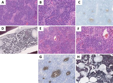 Figure2 The Pathological Findings Of Cervical Lymph Nodes And Bone Download Scientific Diagram