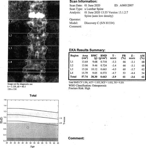 Dualenergy Xray Absorptiometry Scan Report Of A Yold Patient