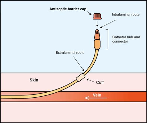 Antiseptic Barrier Caps To Prevent Central Line Associated Bloodstream