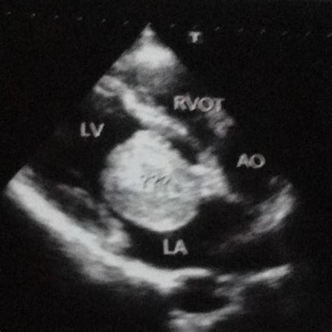 A B C Illustration Of The Excision Of Left Atrial Myxoma Through A