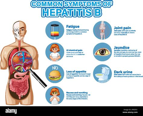 Informative Poster Of Common Symptoms Hepatitis B Illustration Stock