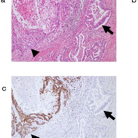 He Staining Of Adenosquamous Carcinoma A The Adenocarcinoma