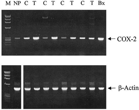 Rt Pcr Analysis Of Cox 2 Mrna Expression In Pancreatic Adenocarcinomas