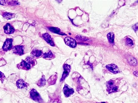 Conociendo Un Poco Mejor Al Liposarcoma Mixoide Asociación Iker